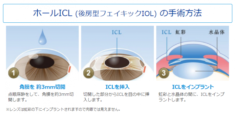 Icl 手術 Icl手術とは Sidecrance